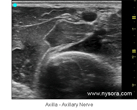 Ultrasound image of the axillary nerve