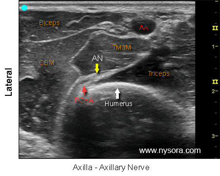 Ultrasound image of the labeled axillary nerve