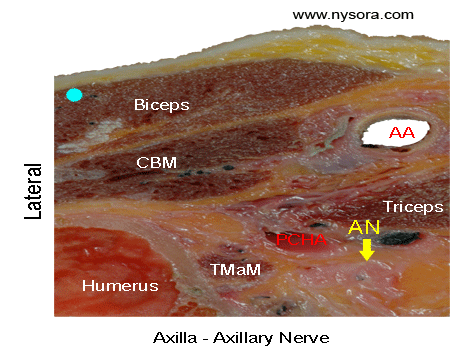 Cross sectional anatomy of the axillary nerve