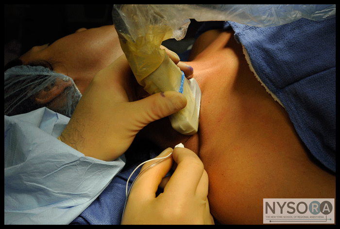 Ultrasound-Guided Superficial Cervical Plexus Block