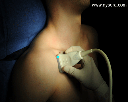 Ultrasound transducer position to image the infraclavicular brachial plexus transverse view