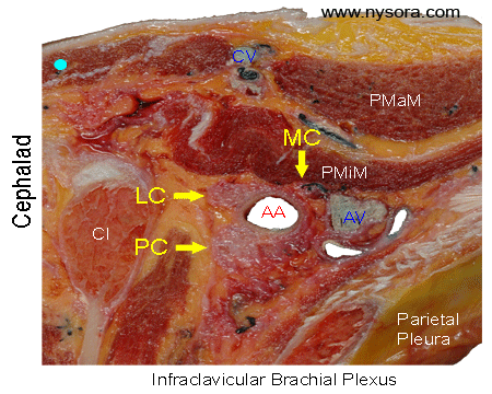 Cross sectional anatomy of the infraclavicular brachial plexus