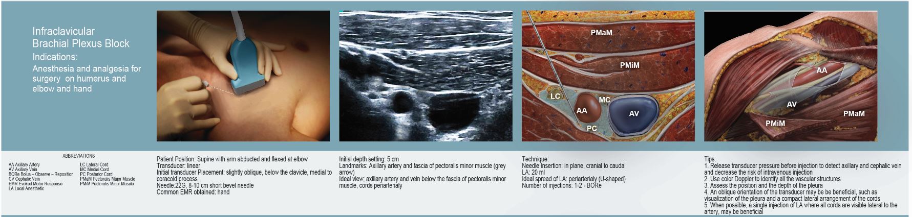 Infraclavicular Brachial Plexus Block section from 2<sup>nd</sup> Generation Poster