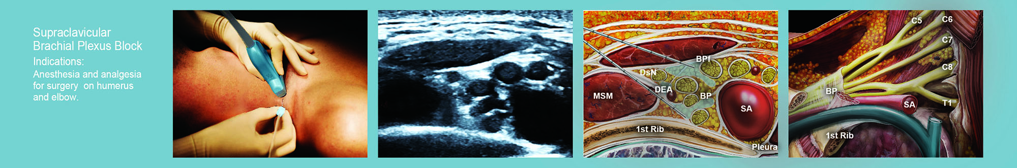 SNEAK PREVIEW: NYSORA 2nd Edition of Standard PNB Techniques: Supraclavicular Brachial Plexus Block.