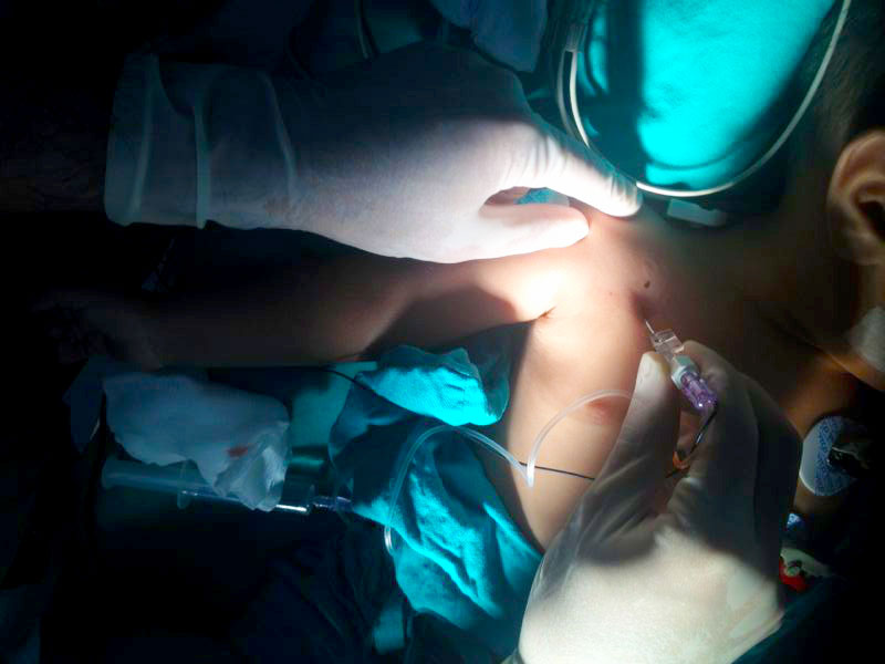 Javier performing a Nerve stimulator - guided infraclavicular block on a 1 year old