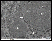 Neurologic Complications of Peripheral Nerve Blocks