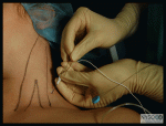 Interscalene Brachial Plexus Block