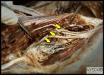 Lumbar Plexus Block