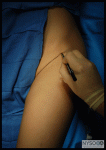 Femoral Nerve Block