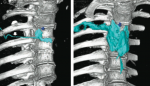 Thoracic Paravertebral Block