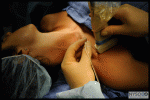 Figure 8: Patient position, imaging and needle placement for continuous infraclavicular brachial plexus block are similar to those in a single-injection technique. Once the proper needle tip is determined by injection of a small volume of local anesthetic