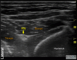 Ultrasound-Guided Forearm Block