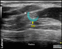 Ultrasound-Guided Wrist Block