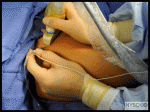 Ultrasound-Guided Femoral Nerve Block