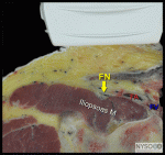 Ultrasound-Guided  Femoral Nerve  Block