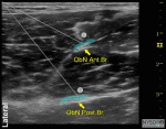 Ultrasound-Guided Obturator Nerve Block