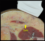 Ultrasound-Guided Saphenous Nerve Block