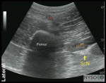 Sciatic Nerve Block: Anterior / Transgluteal / Subgluteal Approach