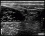 Ultrasound-Guided Ankle Block