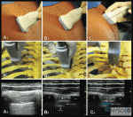 Thoracic Paravertebral Block