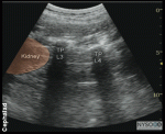 Lumbar Plexus Block