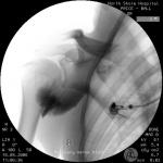 Combined Suprascapular and Axillary (Circumflex) Nerve Block: The Shoulder Block