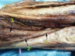 The Anatomical Characteristics Of A Common Epineural Sheath In The Popliteal Fossa