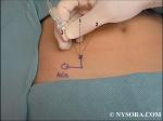 Figure 3: Needle maneuvers to block to ilioinguoinal nerve. Shown is perpendicular needle insertion (1), lateral (2), and medial (3) redirections (fan technique).