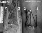 Simplified Landmarks For Popliteal Block