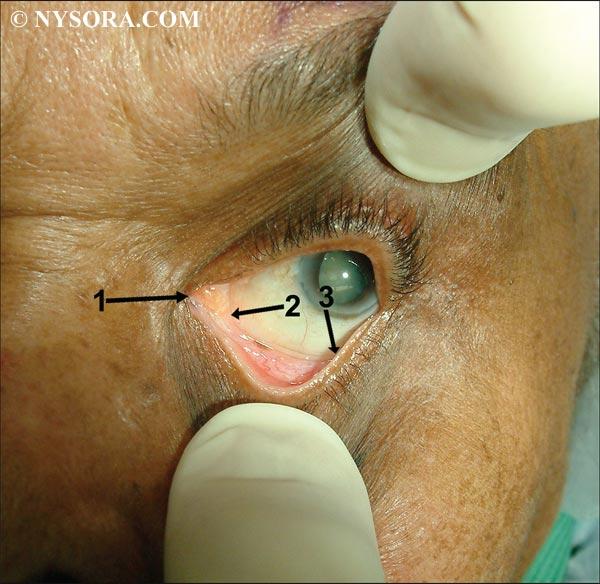 Local & Regional Anesthesia for Eye Surgery