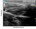 Mandibular Nerve