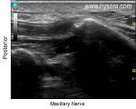 Maxillary Nerve