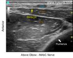 Median Nerve Elbow