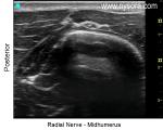 Radial Nerve at the Humerus