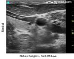 Stellate Ganglion