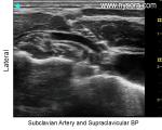 Subclavian Artery