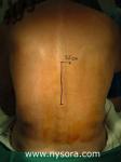 Thoraco Lumbar Paravertebral Block