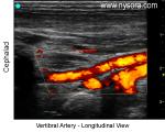 Vertebral Artery