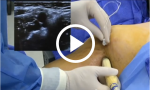 Ultrasound-Guided Axillary Brachial Plexus Block