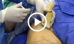 Ultrasound-Guided Femoral Nerve Block