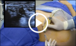 Ultrasound-Guided Interscalene Brachial Plexus Block