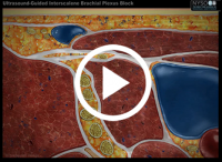 Ultrasound-Guided Interscalene Brachial Plexus Block