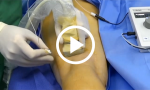 Ultrasound-Guided Popliteal Block