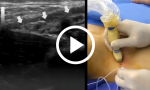 Ultrasound-Guided Supraclavicular Brachial Plexus Block